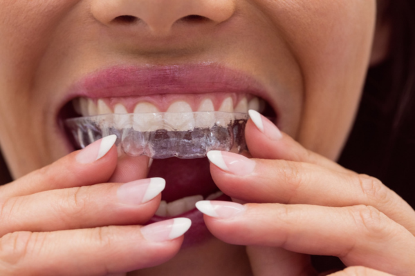 Dental Implant