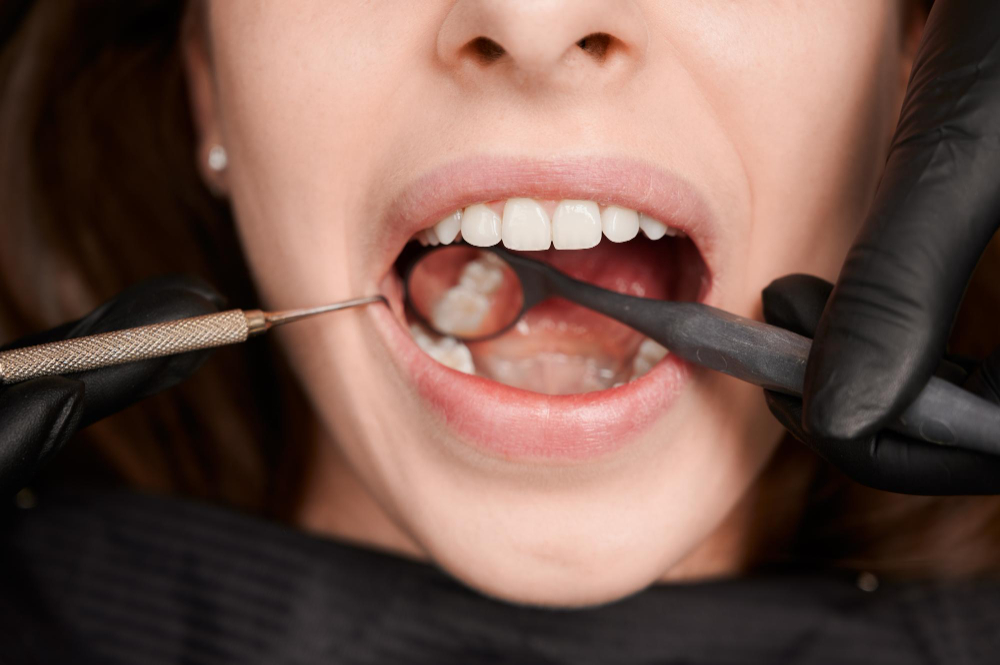 Dental Implant